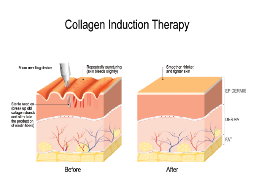 AGUJAS PARA MICRONEEDLING