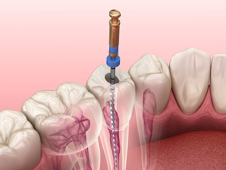 ENDODONCIA
